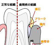 正常な組織と歯周病の組織