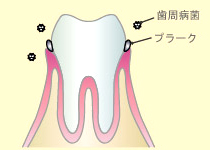 歯周病：初期段階（歯肉炎）