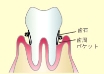 歯周病：第1段階（歯周炎第1～2度）