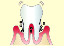 歯周病：第2段階（歯周炎第3～4度）