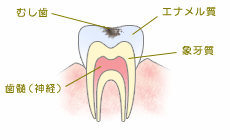 虫歯の進行：C1