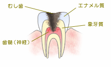 虫歯の進行：C3